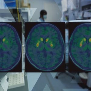 Como funciona a terapia celular que tenta restaurar a dopamina no cérebro de pacientes com Parkinson