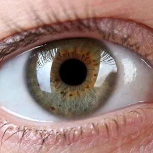 Maioria dos casos de cegueira pode ser evitada, mas diagnóstico ainda falha