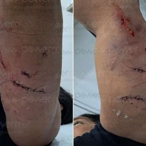 Cachorro solto ataca mulher que tentava salvar pets e deixa vítima ferida em Nova Mutum; veja vídeo