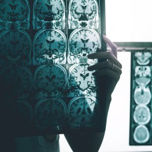 Proteína ligada ao Alzheimer se espalha pelo cérebro por conexões entre neurônios, mostra estudo