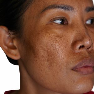 Melasma e dieta: como a alimentação ajuda a tratar manchas na pele