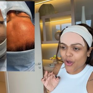 Influenciadora Camila Loures retira 'veia saltada' na testa; procedimento carece de respaldo científico