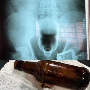 Objetos presos no reto levam pacientes ao centro cirúrgico; médicos explicam por que isso acontece e como evitar