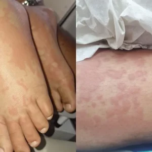 Exame descarta contaminação por detergente em criança internada no RN