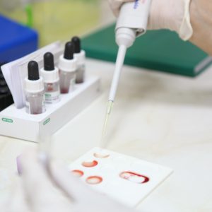 Exame de sangue para Alzheimer detecta sinais anos antes dos sintomas