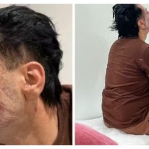 CFM muda regras e autoriza uso médico de fenol; Anvisa mantém proibição para estética