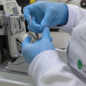 SUS inclui nova terapia para pacientes adultos com leucemia mieloide