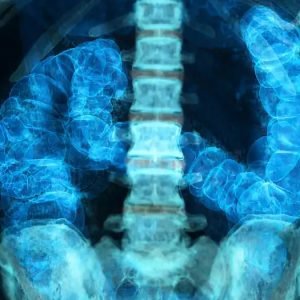 Câncer no intestino: brasileiros desconhecem exame preventivo