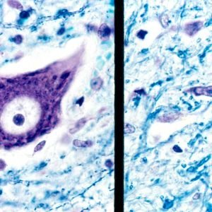 Proteínas no sangue mudam anos antes da ELA e podem prever quando a doença vai começar