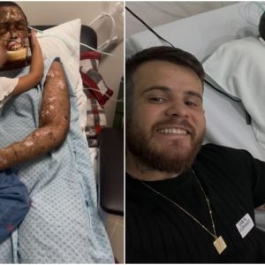 O que é o xeroderma pigmentoso, a doença rara que faz do sol um risco de câncer e causou a morte de Káh Felipe