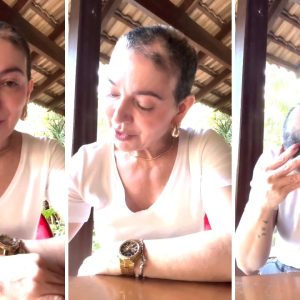 Alopecia areata: sintomas, tratamentos e o caso de Karina Lucco