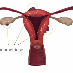 'Tomava morfina para a dor até que os médicos descobriram que eu tinha endometriose aos 13 anos'