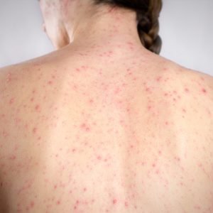 Sarampo: morte, inflamação no cérebro e infecções; entenda os riscos da doença que pode ser evitada com vacinação