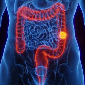 SUS inclui novo teste para rastreamento de câncer de intestino