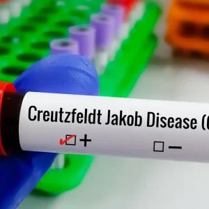 Entenda Doença de Creutzfeldt-Jakob e busca por tratamento