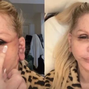 Monique Evans faz procedimento no rosto e revela que ficou “irreconhecível”