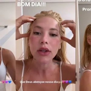 “Reações são esperadas”, dizem especialistas após procedimento de Virginia