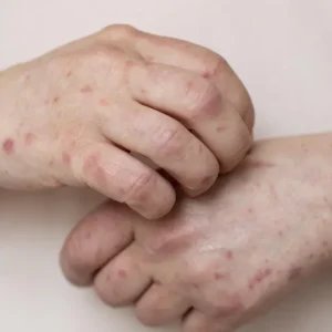 Casos de sarampo sobem para 23 no estado de São Paulo; veja recomendações