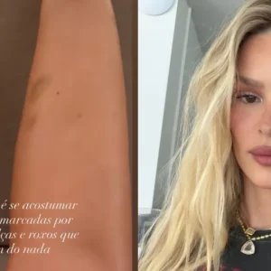 “Roxos aparecem do nada”: Yasmin Brunet mostra hematomas; entenda lipedema