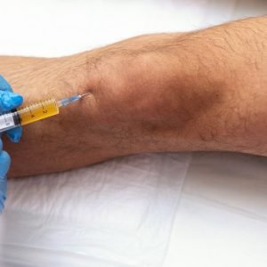 Infiltração no joelho não é solução para todos: entenda benefícios, limites e riscos