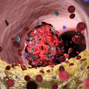 Placas de gordura que podem levar ao infarto já aparecem aos 20 anos e atingem metade dos homens aos 40