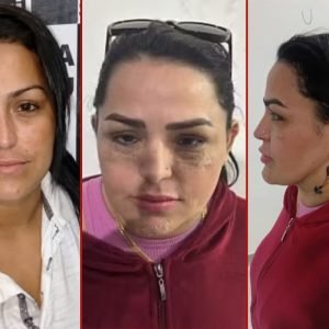 Chefe de facção em MT fez harmonização facial enquanto estava foragida