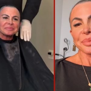 Crostas após transplante capilar são normais? Especialista explica após polêmica de cantora Gretchen com médico de MT