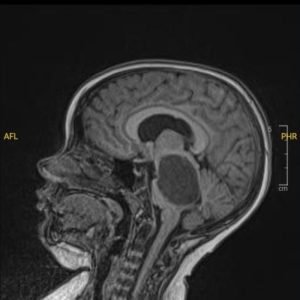 Novo teste pode identificar tipo de tumor cerebral em menos de duas horas e acelerar diagnóstico