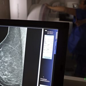 Entidades alertam médicos sobre pedidos de mamografia digital