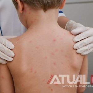 Três casos de meningite viral fazem cidade de MT suspender aulas