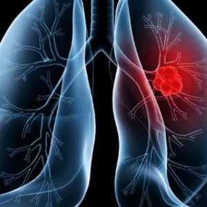 Saiba o que é adenocarcinoma pulmonar, câncer que atinge o Papa Leão XIV