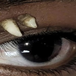 Adolescente na Índia descobre dente crescendo acima do olho; Entenda