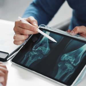 Osteoporose: fatores de risco, causas e formas de prevenção