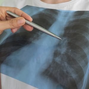 Câncer de pulmão em não fumantes: alerta após caso do Papa Leão XIV