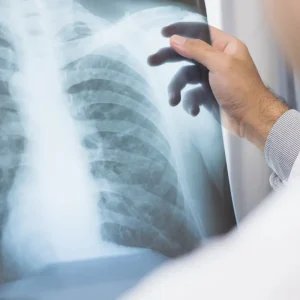 Anvisa aprova novo medicamento para câncer de pulmão avançado
