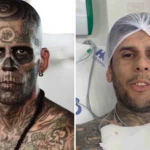 Câncer de bexiga invasivo: entenda tratamento e prognóstico de doença que atinge ‘homem mais tatuado do Brasil’