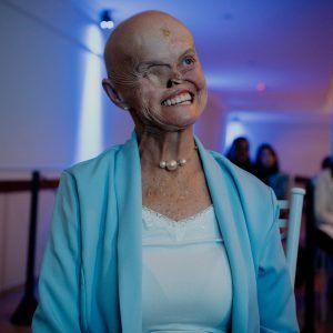 Mulher com síndrome genética rara já teve 73 cânceres de pele e espera cirurgia para reconstruir o nariz