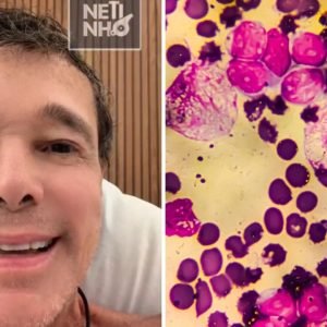 Linfoma não Hodgkin de Netinho: previstos 12,5 mil novos casos anuais