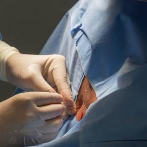 Anvisa soube de 5 mortes quando apenas 19 pacientes tinham recebido polilaminina; laboratório nega relação